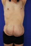 before tummy tuck front arms up view male patient case 5032