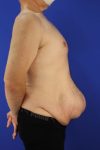 before tummy tuck right side view male patient case 5032