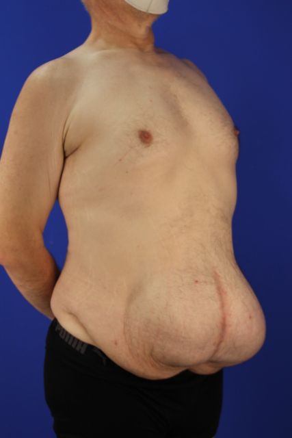 before tummy tuck right angle view male patient case 5032