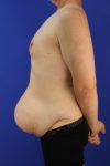 before tummy tuck left side view male patient case 5032