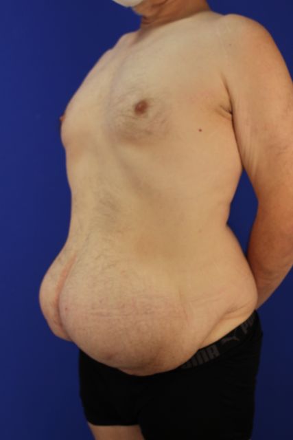 before tummy tuck left angle view male patient case 5032